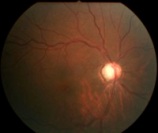 Open-angle Glaucoma